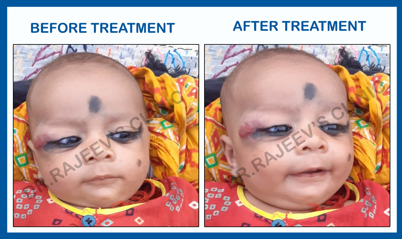 HEMANGIOMA