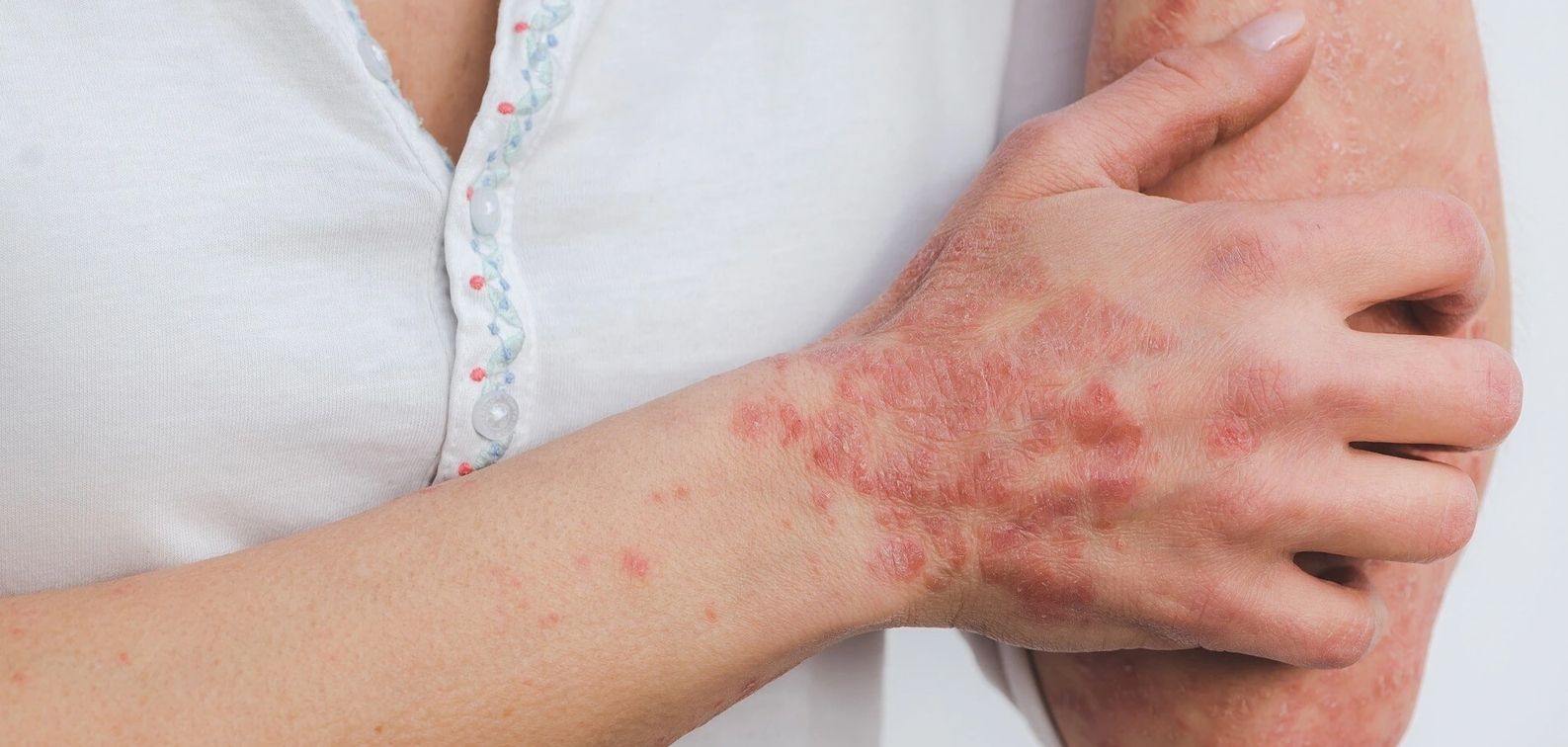 PSORIASIS - TREATMENT In HOMEOPATHY