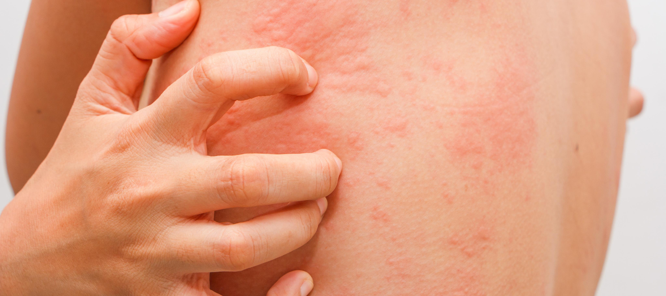 URTICARIA - EFFECTIVE TREATMENT IN HOMEOPATHY