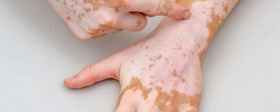 VITILIGO - EFFECTIVE TREATMENT IN HOMEOPATHY