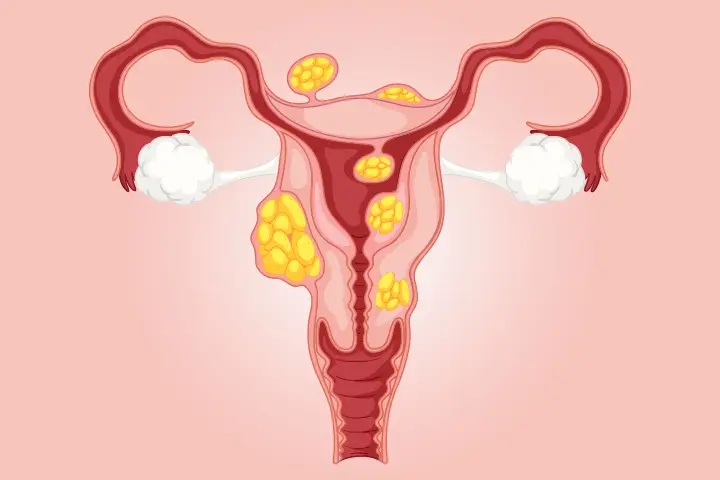  Know More About Uterine Fibroid?