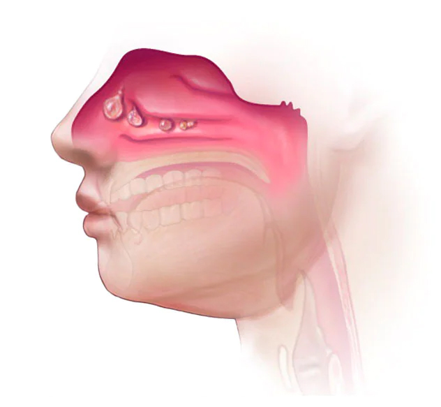 Nasal polyp