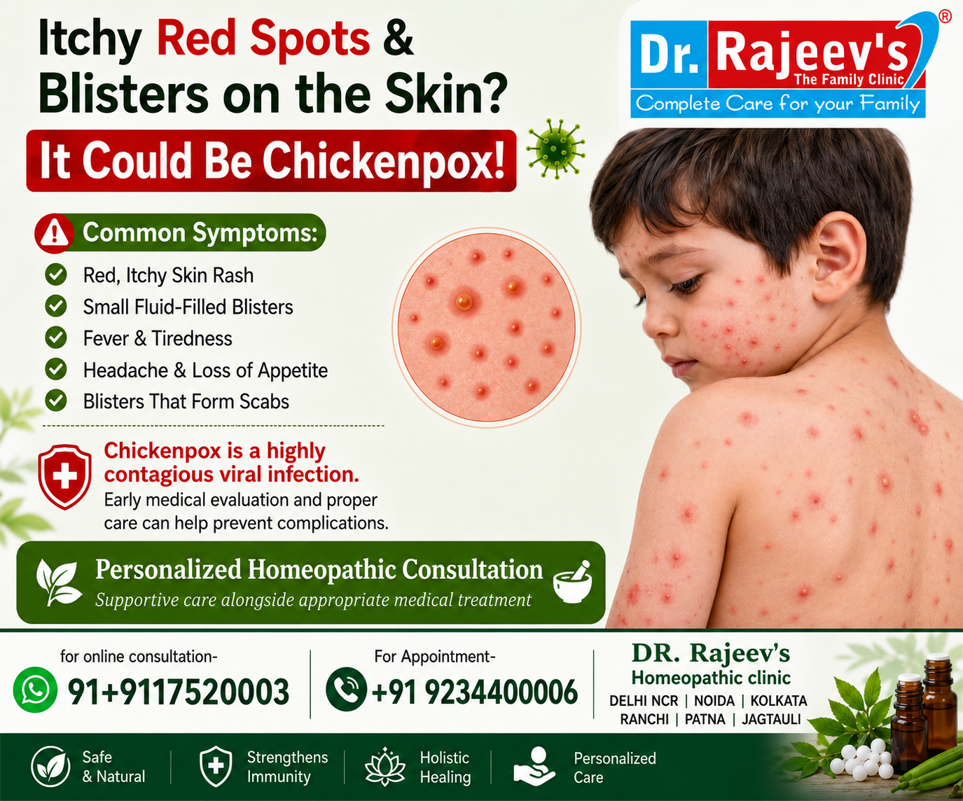 Varicella (Chickenpox): Symptoms, Causes  Homeopathic Treatment for Healthy Skin