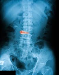 HOMEOPATHIC PLAYS IMPORTANT ROLE IN ANKYLOSING SPONDYLITIS