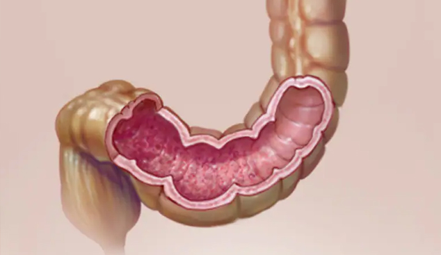 ULCERATIVE COLITIS AND ITS HOMOEOPATHIC MANAGEMENT