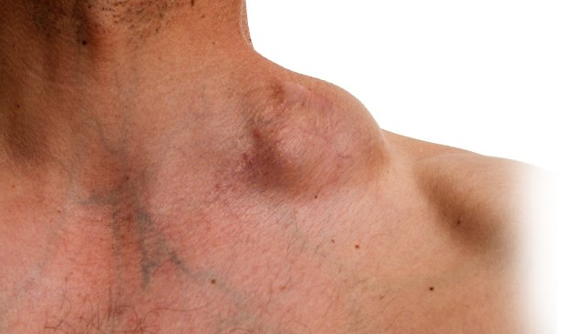 HODGKIN'S LYMPHOMA (HL) AND ITS HOMOEOPATHIC ASPECTS