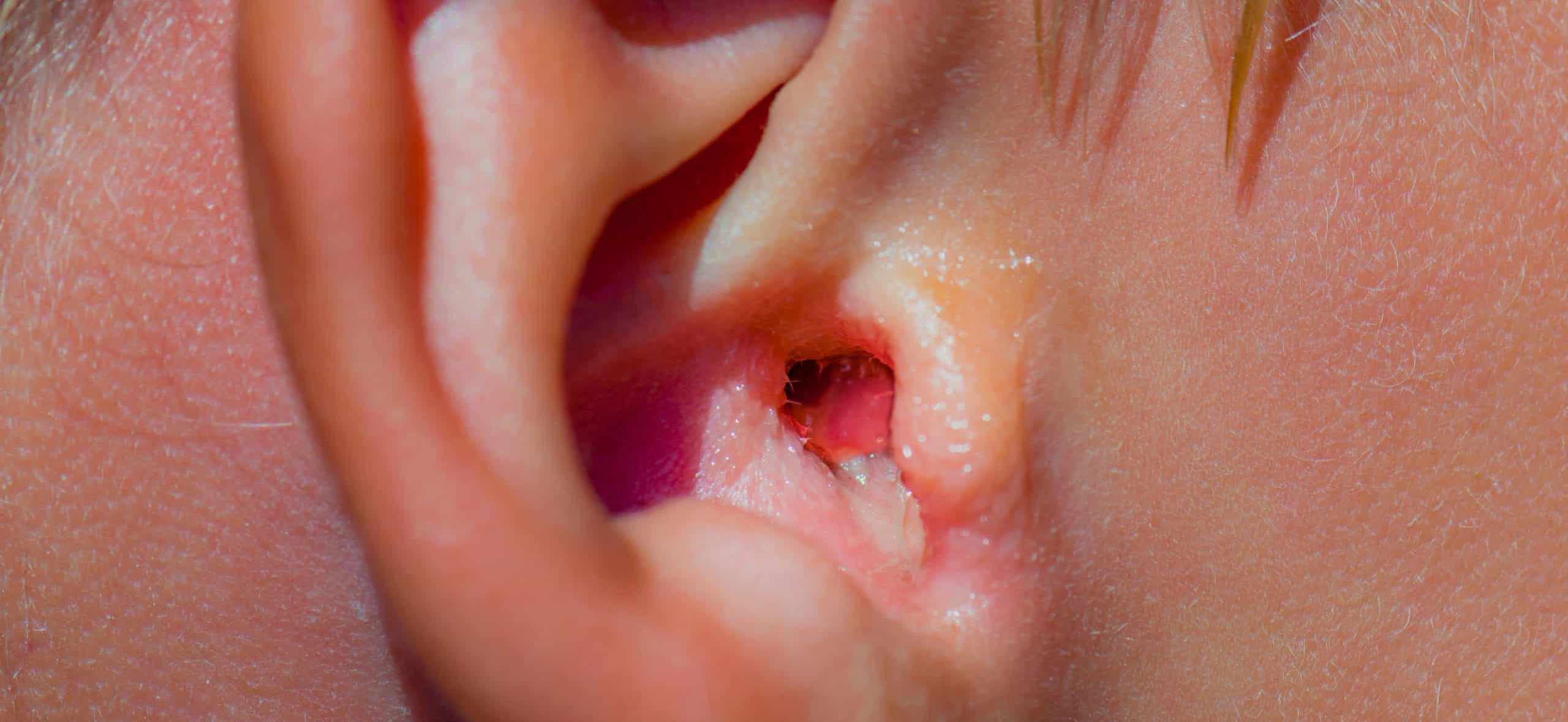 CHRONIC EXTERNAL OTITIS