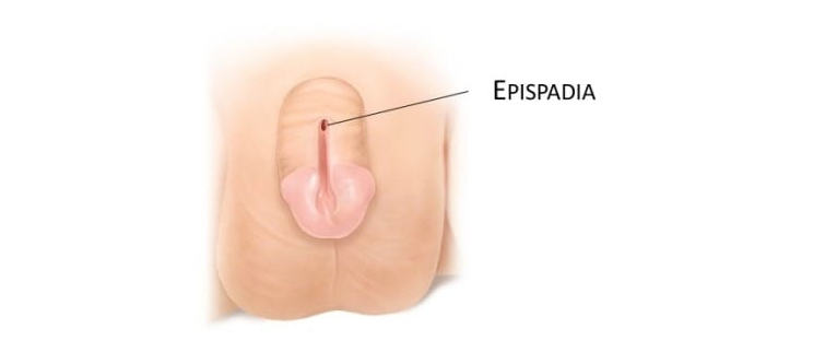 EPISPADIAS TREATMENT THROUGH HOMEOPATHY