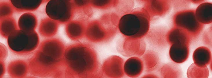 MACROCYTIC ANEMIA AND EFFECT OF HOMOEOPATHY OVER IT