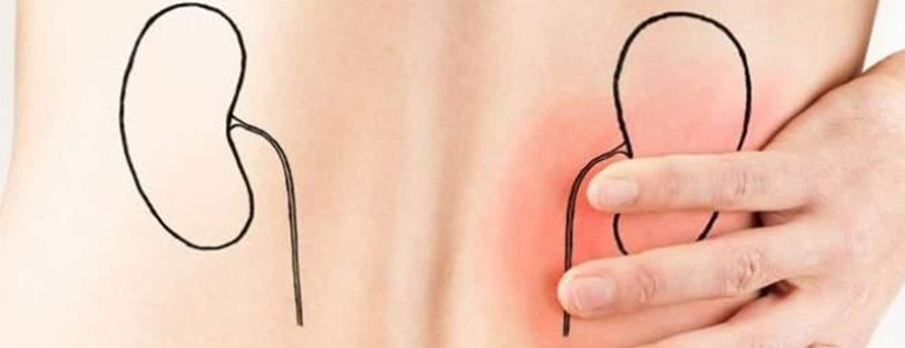 RENAL COLIC TREATMENT IN HOMEOPATHY