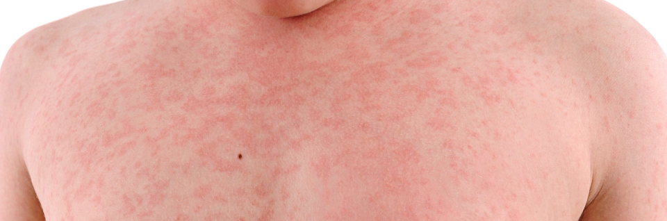 HEAT RASH TREATMENT THROUGH HOMEOPATHY