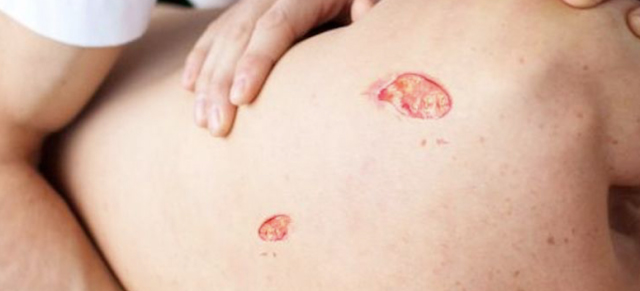 Treatment of Bedsores in Homeopathy