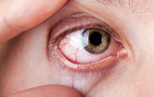 SICCA SYNDROME AND HOW HOMOEOPATHY CAN INFLUENCE THE CONDITION