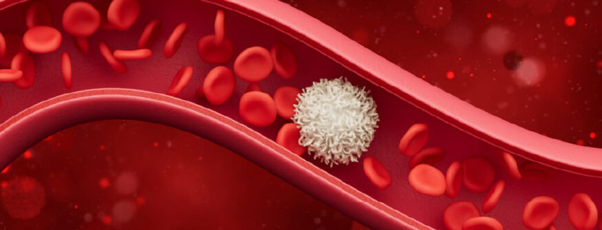 SIDEROBLASTIC ANAEMIA AND HOW HOMEOPATHY TACKLES IT