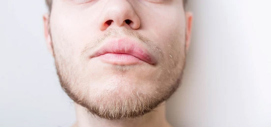 Angioedema Treatment through Homeopathy