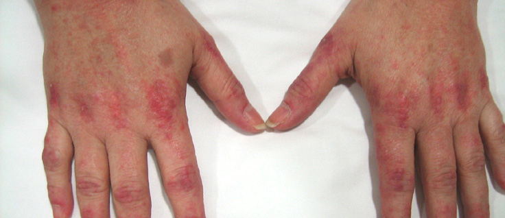 AUTOIMMUNE MYOSITIS AND EFFECT OF HOMOEOPATHIC REMEDIES OVER IT