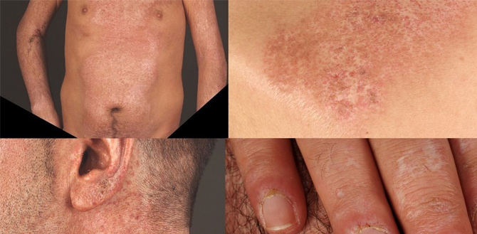 MIXED CONNECTIVE TISSUE DISEASE TREATMENT