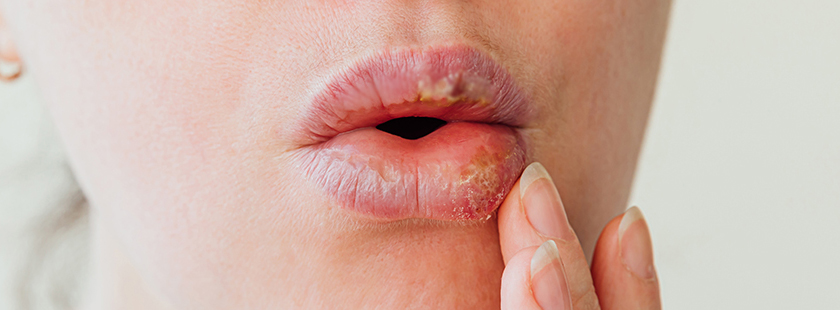 LIP SWELLING TREATMENT