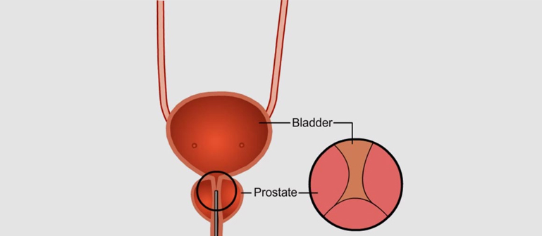 PROSTATE ABSCESSES TREATMENT