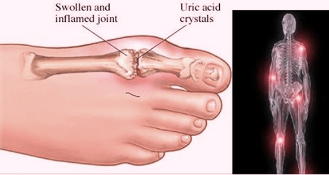 URIC ACID