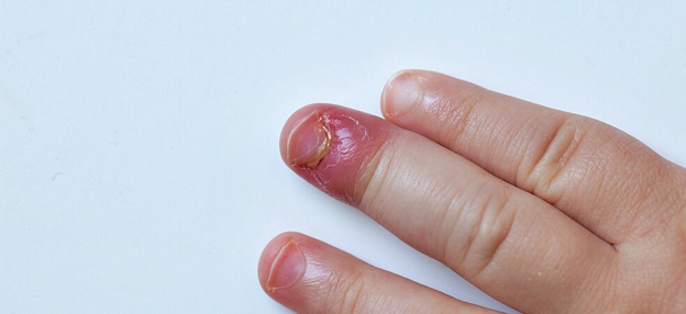 PARONYCHIA TREATMENT