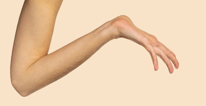 MARFAN SYNDROME TREATMENT