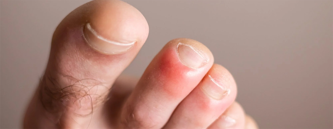 CHILLBLAINS TREATMENT