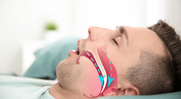  PRIMARY SNORING & OBSTRUCTIVE SLEEP APNEA