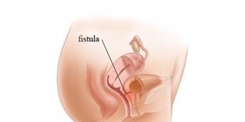 VAGINAL FISTULA AND HOW HOMOEOPATHY TACKLES IT