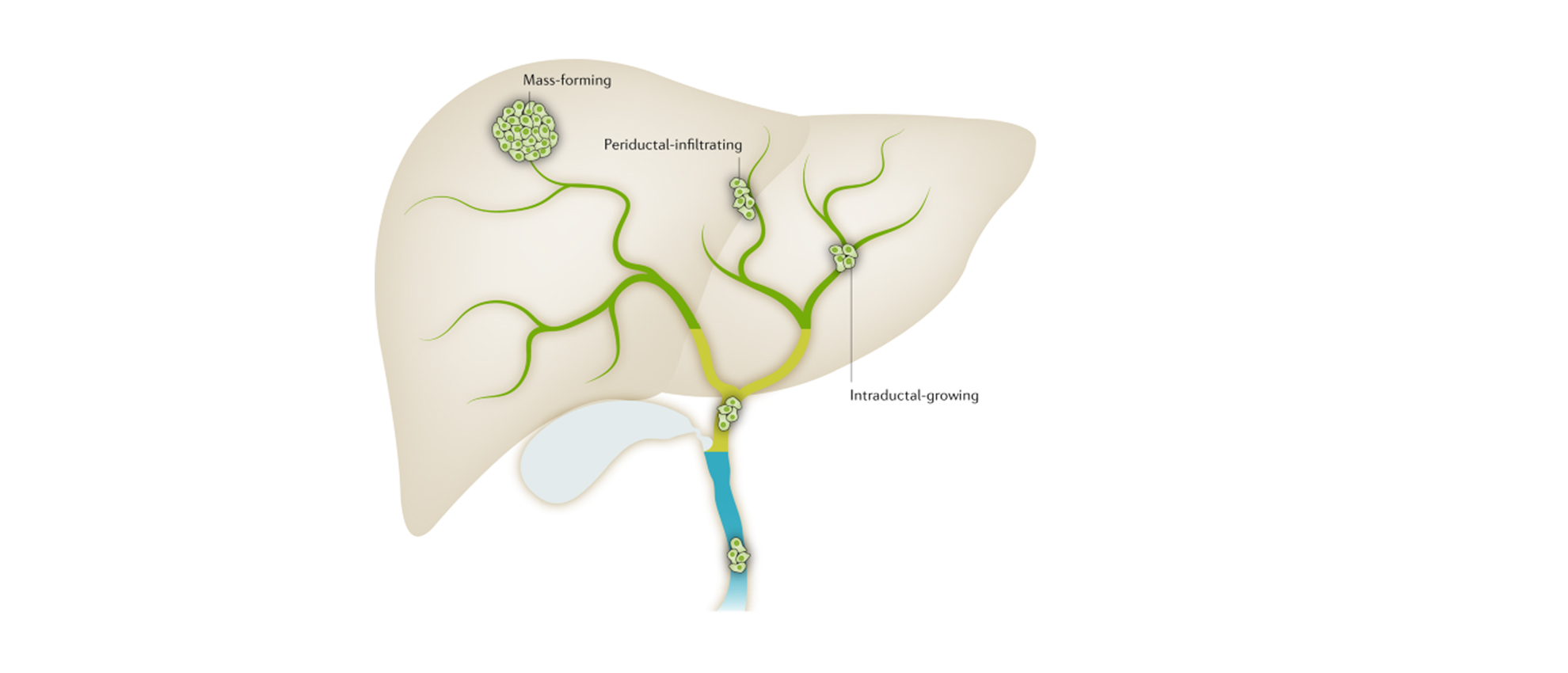 CHOLANGIOCARCINOMA AND EFFECT OF HOMOEOPATHIC REMEDIES IN MANAGING IT