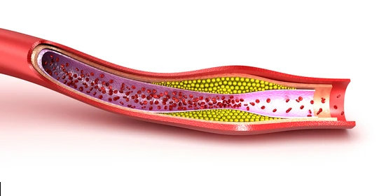 DYSLIPIDEMIA (Hyperlipidemia) TREATMENT