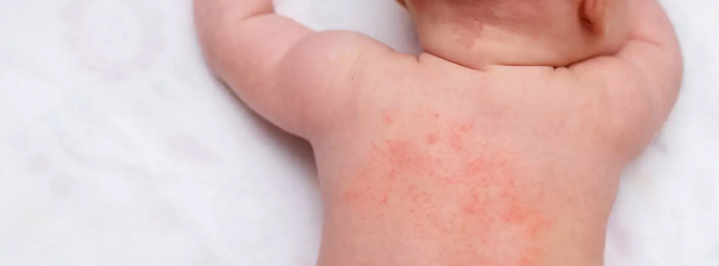 WISKOTT-ALDRICH SYNDROME TREATMENT