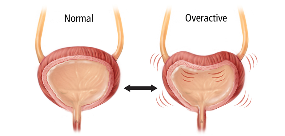 OVERACTIVE  BLADDER