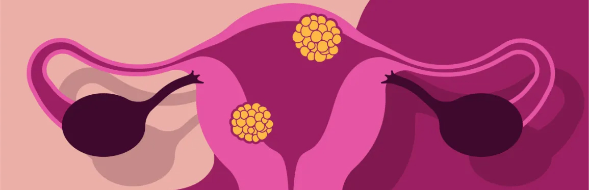 BACTERIAL VAGINOSIS AND EFFECT OF HOMOEOPATHY ON IT
