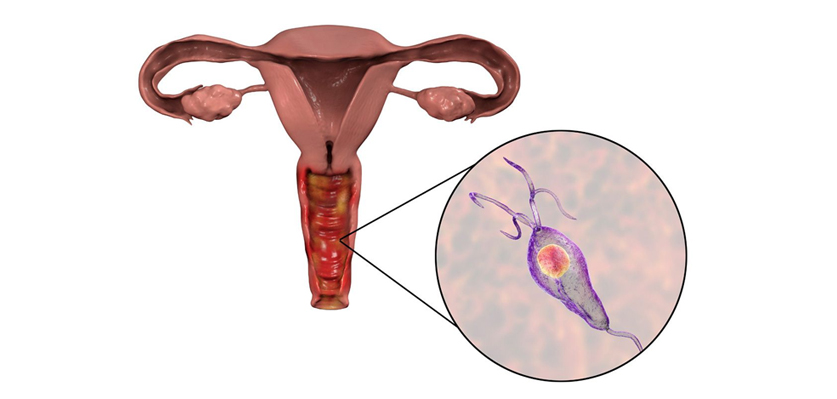 TRICHOMONIASIS AND ITS MANAGEMENT BY HOMOEOPATHIC REMEDIES