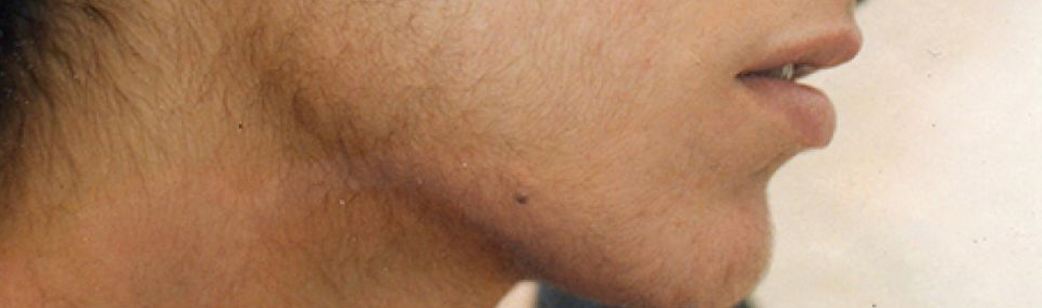 ADRENAL VIRILISM TREATMENT