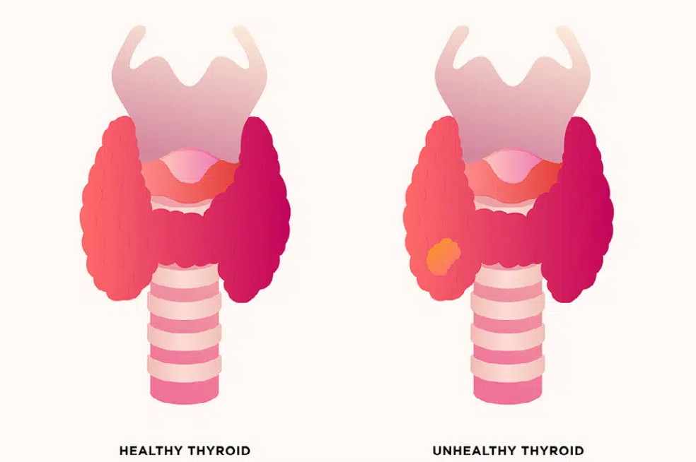 EUTHYROID SICK SYNDROME