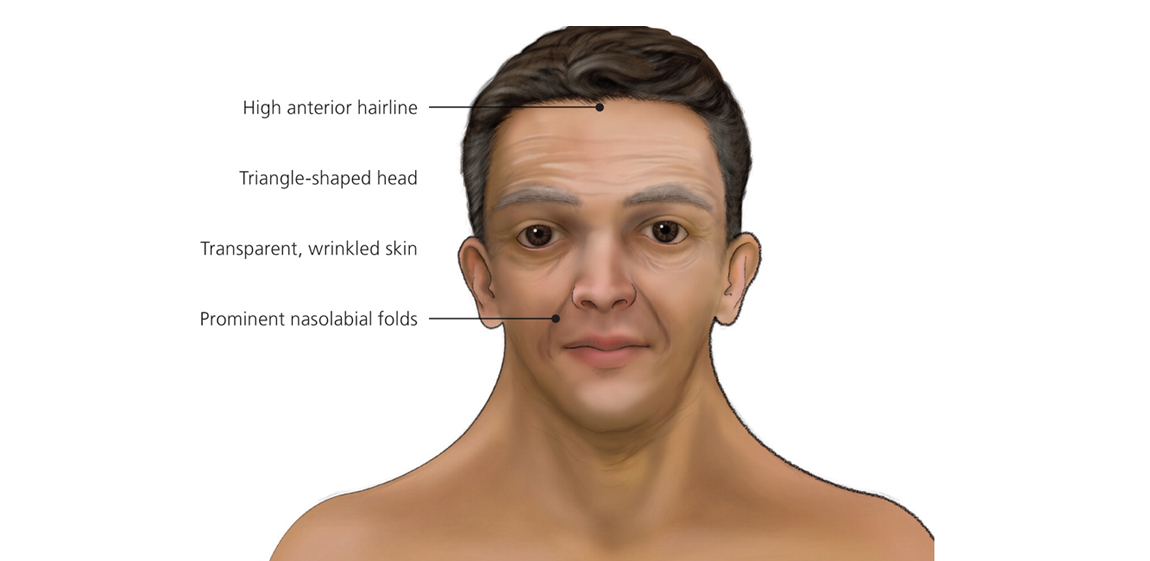 NOONAN SYNDROME TREATMENT