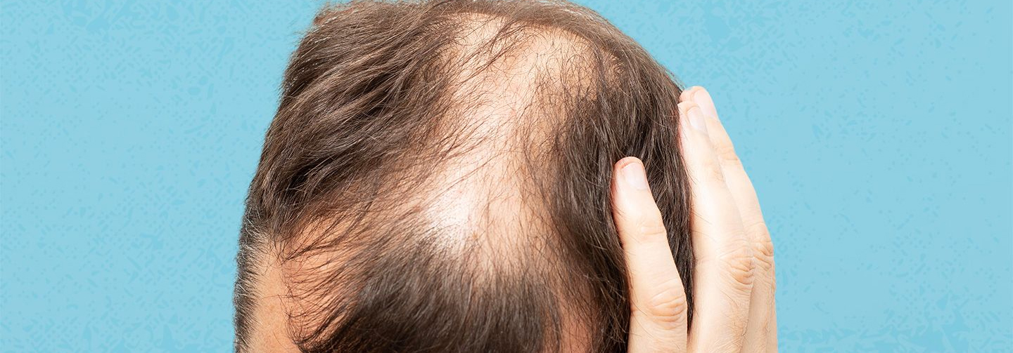 ANDROGENIC ALOPECIA OR MALE PATTERN BALDNESS