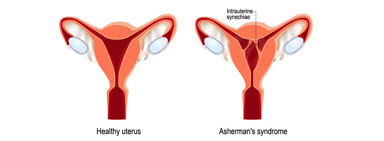 ASHERMANN SYNDROME AND EFFECT OF HOMOEOPATHIC REMEDIES ON IT
