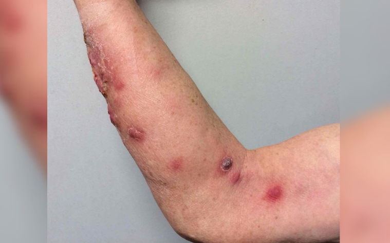 SPOROTRICHOSIS TREATMENT