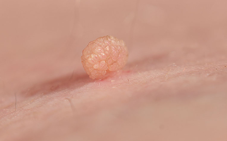 SKIN TAG TREATMENT