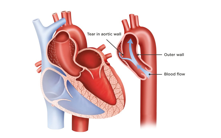 AORTIC DISSECTION TREATMENT