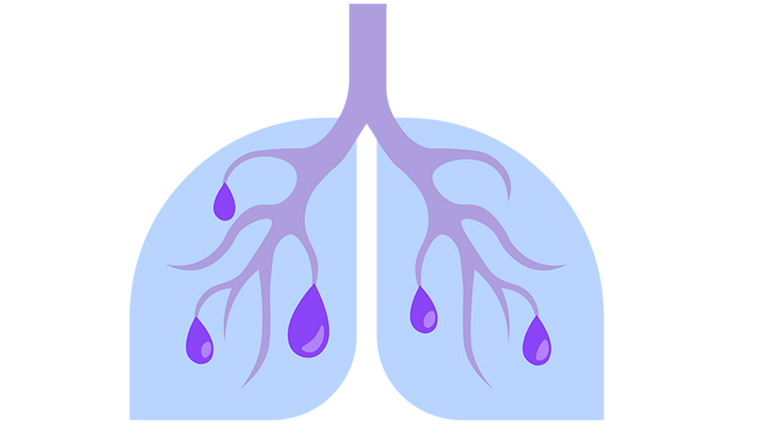 BRONCHOGENIC CYSTS