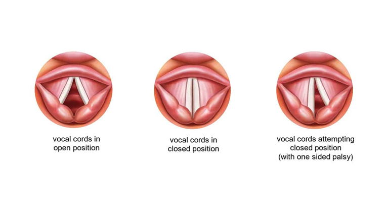VOCAL FOLD IMMOBILITY 