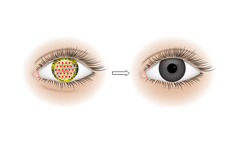 CYSTINOSIS TREATMENT