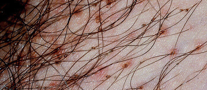 PEDICULOSIS TREATMENT