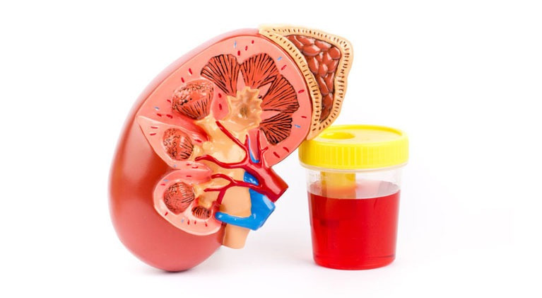 BLEEDING FROM URINARY TRACT