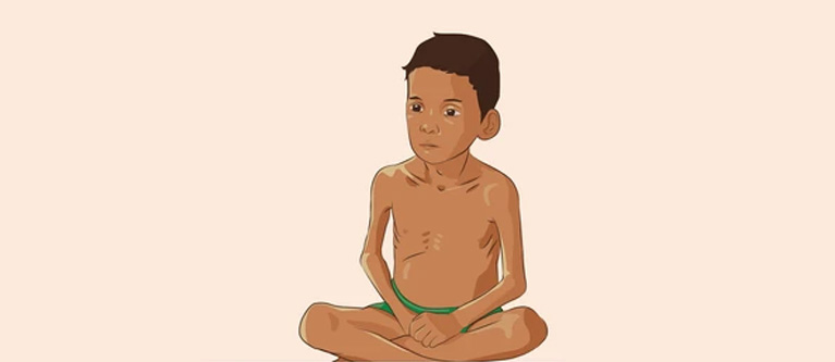 PROTEIN ENERGY MALNUTRITION