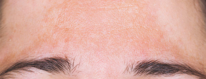 CHLOASMA TREATMENT